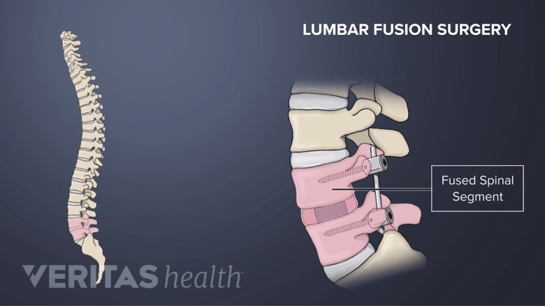 Bone Is Fusing Allograft: Bone Graft from a Donor | Spine-health