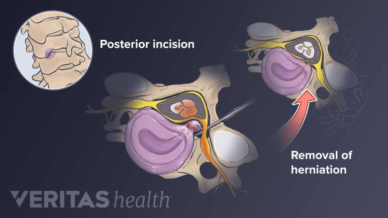 Posterior Cervical Decompression (Microdiscectomy) Surgery | Spine-health