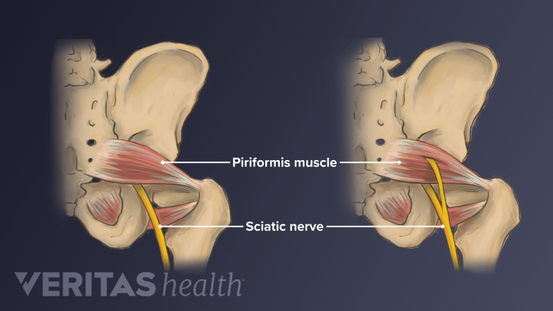 Causes Of Piriformis Syndrome Spine health causes-of-piriformis-syndrome-spine-health