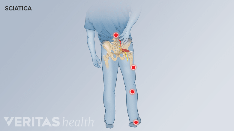 Understanding Sciatica Symptoms: Pins and Needles, Numbness, Icy, and ...