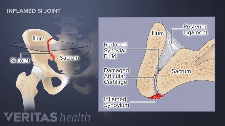 How Long Does SI Joint Pain Last? | Spine-health