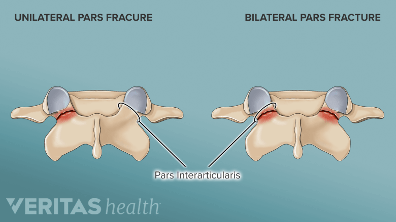 Spondylolysis and Spondylolisthesis | Spine-health