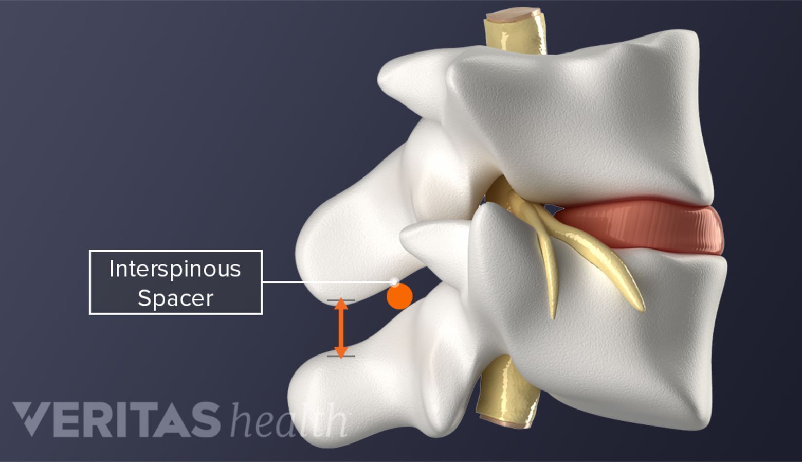 Spinal Stacking Lumbar Spinal Stenosis Surgery Options | Spine-health
