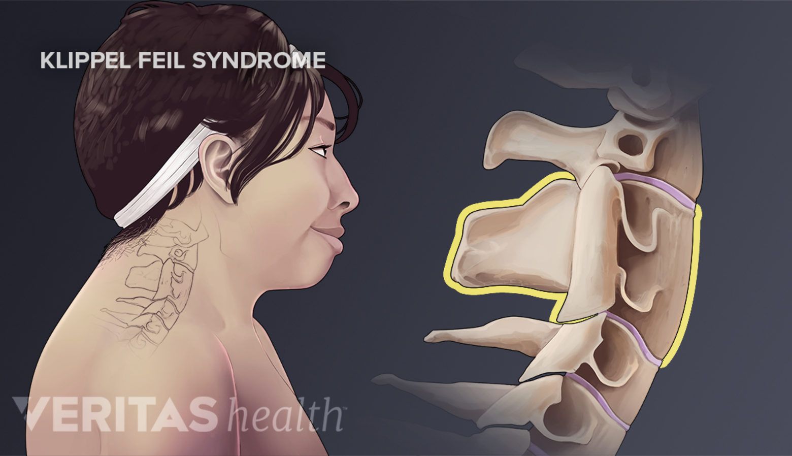 Feil Klippel-Feil Symptoms and Associated Conditions | Spine-health