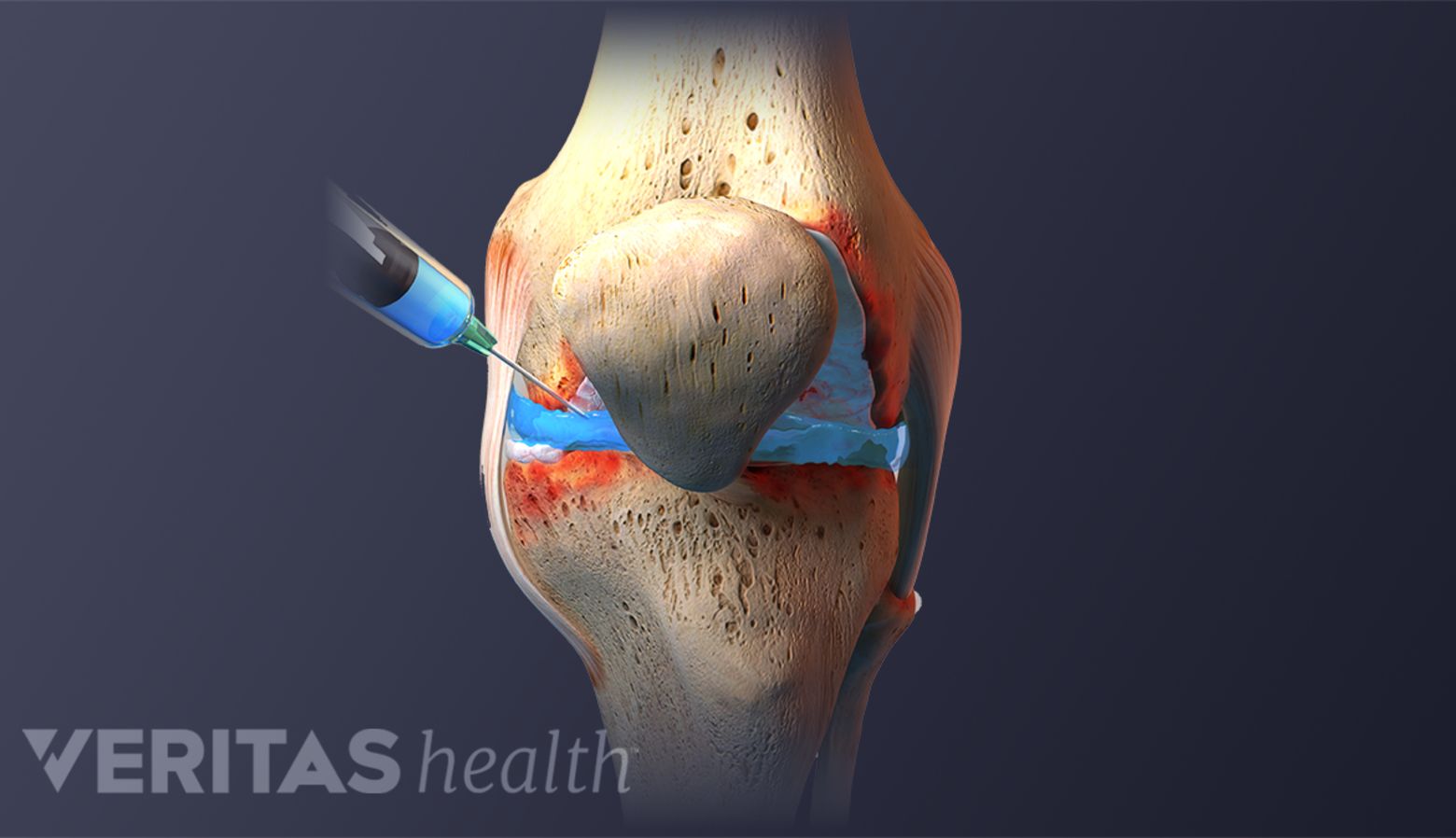 Should You Get a Cortisone Steroid Injection? | Arthritis-health