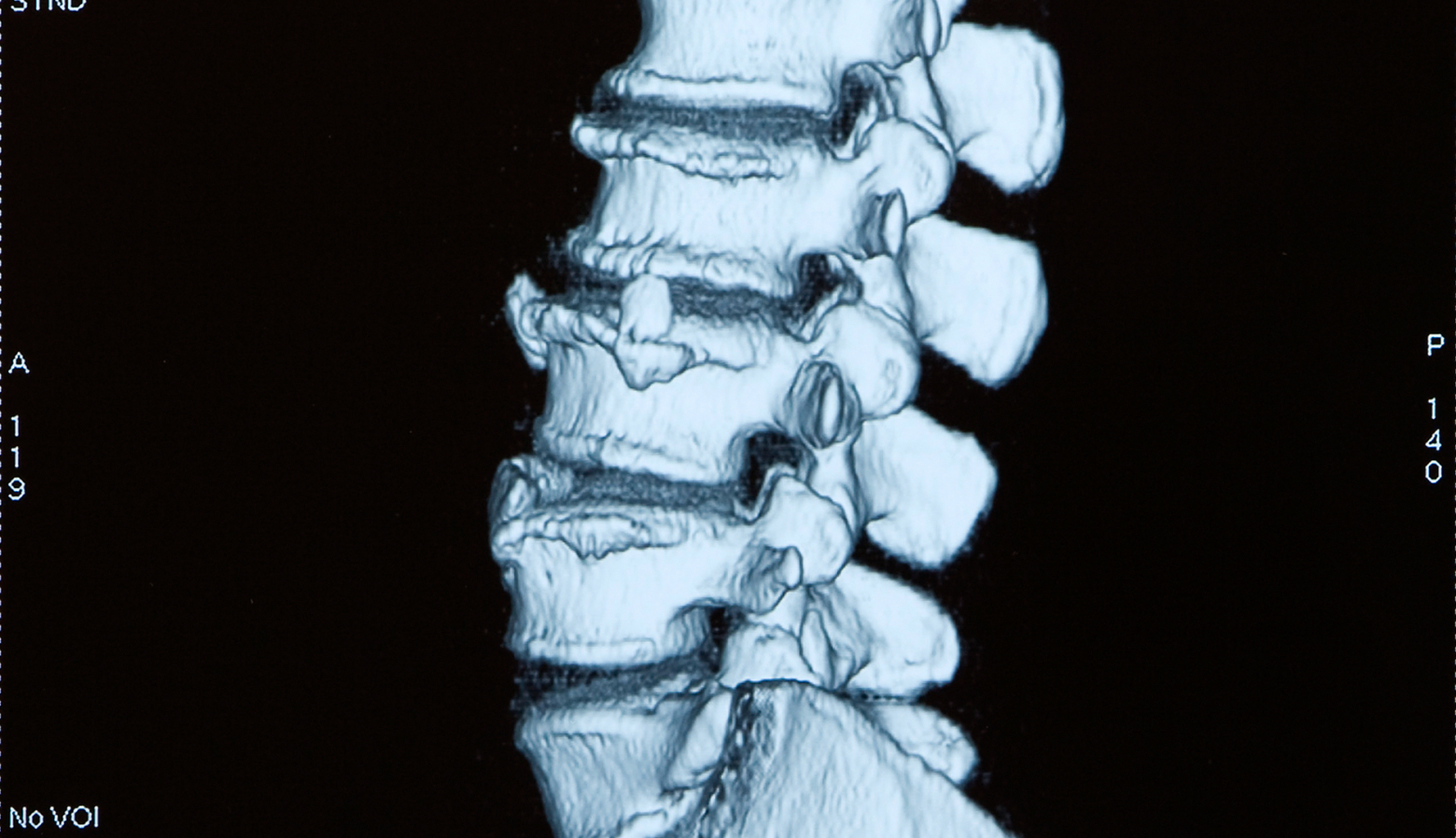 Failed Lumbar Decompression Back Surgery | Spine-health