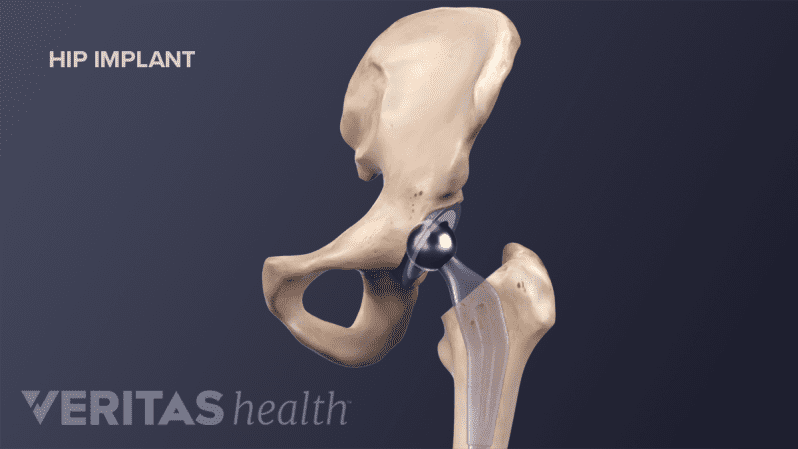 Medical illustration of a placed hip implant