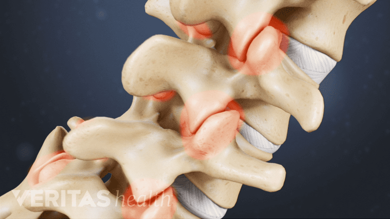 Vertebrae of the spine showing pain at the facet joints