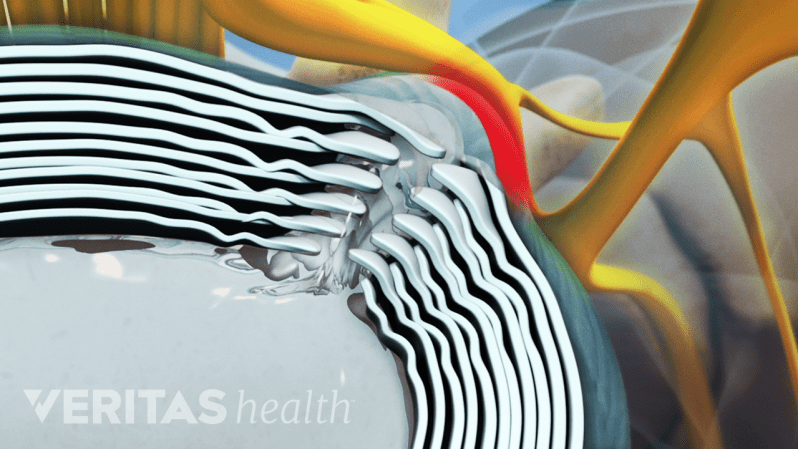 Superior view of a herniated disc.