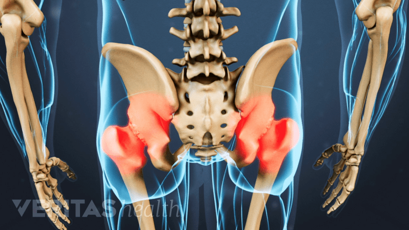 Illustrated skeleton showing the hip joints in red, indicating pain