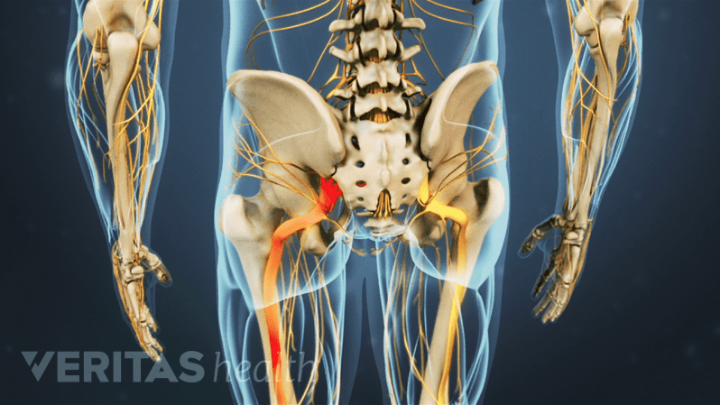 Sciatica Radiating Trusted Information on Back Pain and Neck Pain