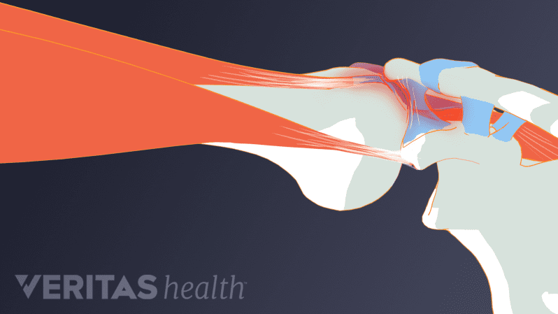 Shoulder impingement illustration