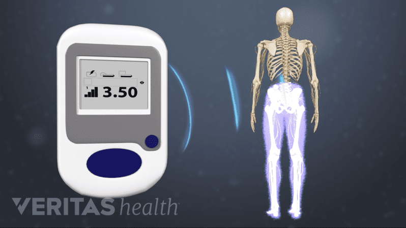 Controller sending pain control signals for lower back pain to generator implanted in the body during spinal cord stimulation