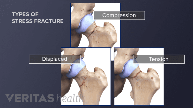 Three types of stress fractures in a hip (tension, displaced, and compression)