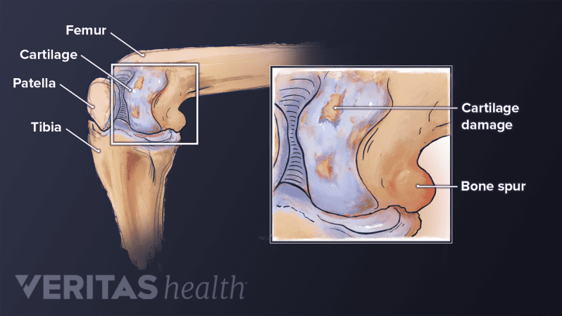 Tibia (shin bone), femur (thigh bone), and patella (kneecap). cartilage damage, and bone spurs labeled in the knee joint.
