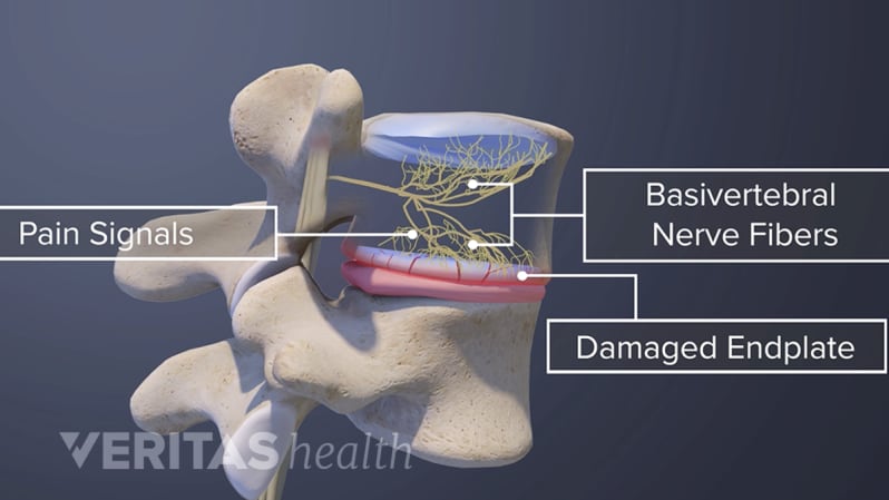 Vertebrogenic Low Back Pain and Damaged End Plate