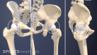 Anterior Posterior Combined Hip Labral Tears