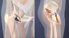 Minimally Invasive Hip Replacement vs. Traditional Hip Replacement