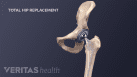 Total Hip Replacement