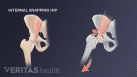 Internal snapping hip syndrome