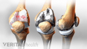 Medical illustration of an arthritic knee joints a front and side view of a replaced knee joint and a re