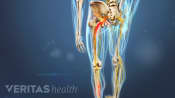 Herniated Disc