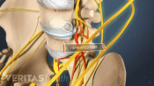 Anterior view of pelvis labeling a lumbar herniated disc