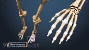 Illustrated skeleton showing arthritis in the metatarsophalngeal joints