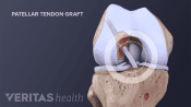 Anterior view of the knee joint showing the femoral tunnel, tibial tunnel, and patellar tendon graft.