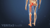 Posterior view of the lower body showing sciatica pain in the legs.