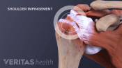 How shoulder impingement affects shoulder movement