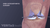 Medical illustration of knee surgery for osteoarthritis