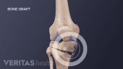 Medical illustration showing parts of the bone that are removed during a tibial osteotomy.