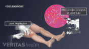 Medical illustration of a knee aspirations and fluid being examined under a microscope