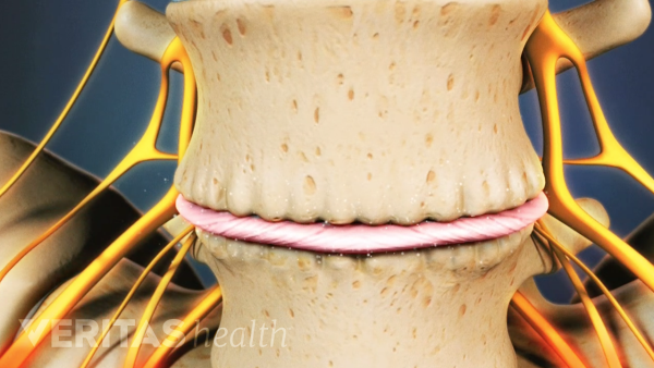 Focused on bone spurs of osteophytes on two vertebra.