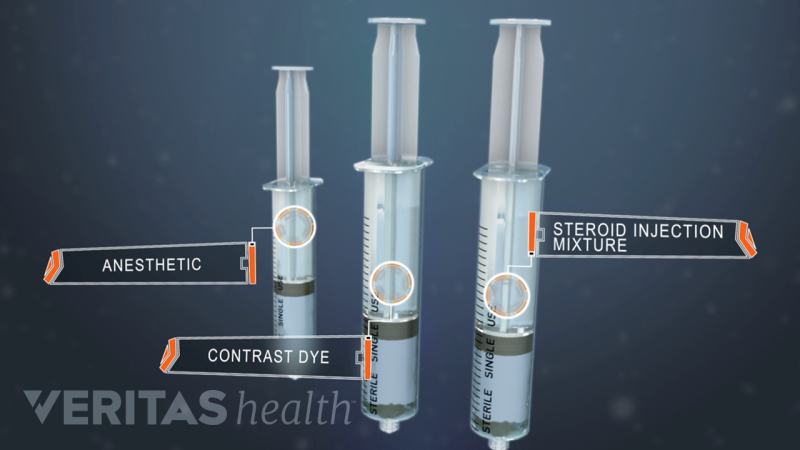 Medical Injection Component Injections | Spine-health