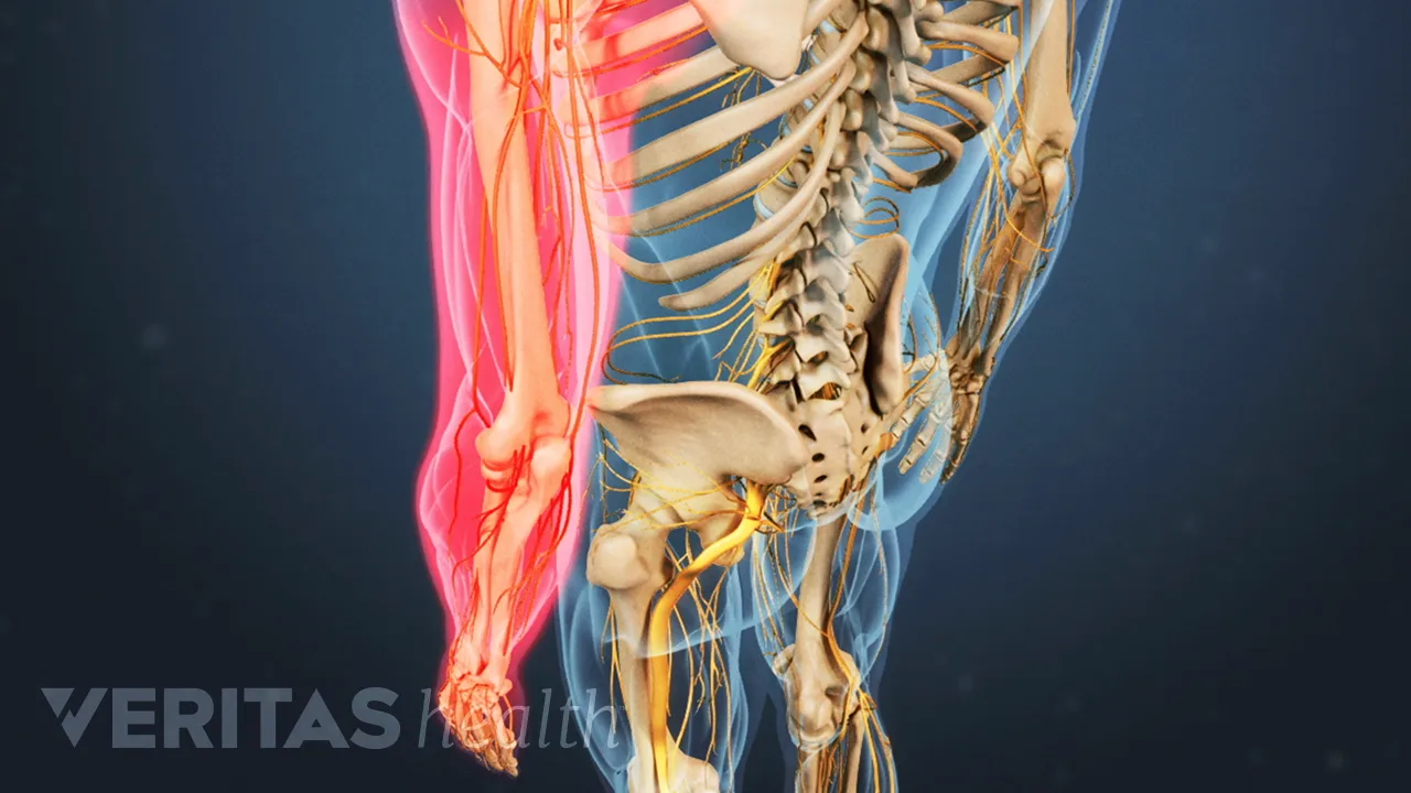 cervical-herniated-disc-arm-pain