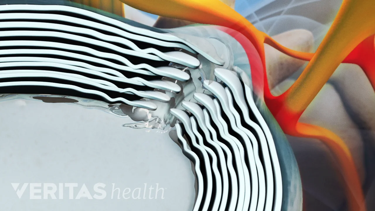 extruded-nucleus-pulposus-nerve-compression