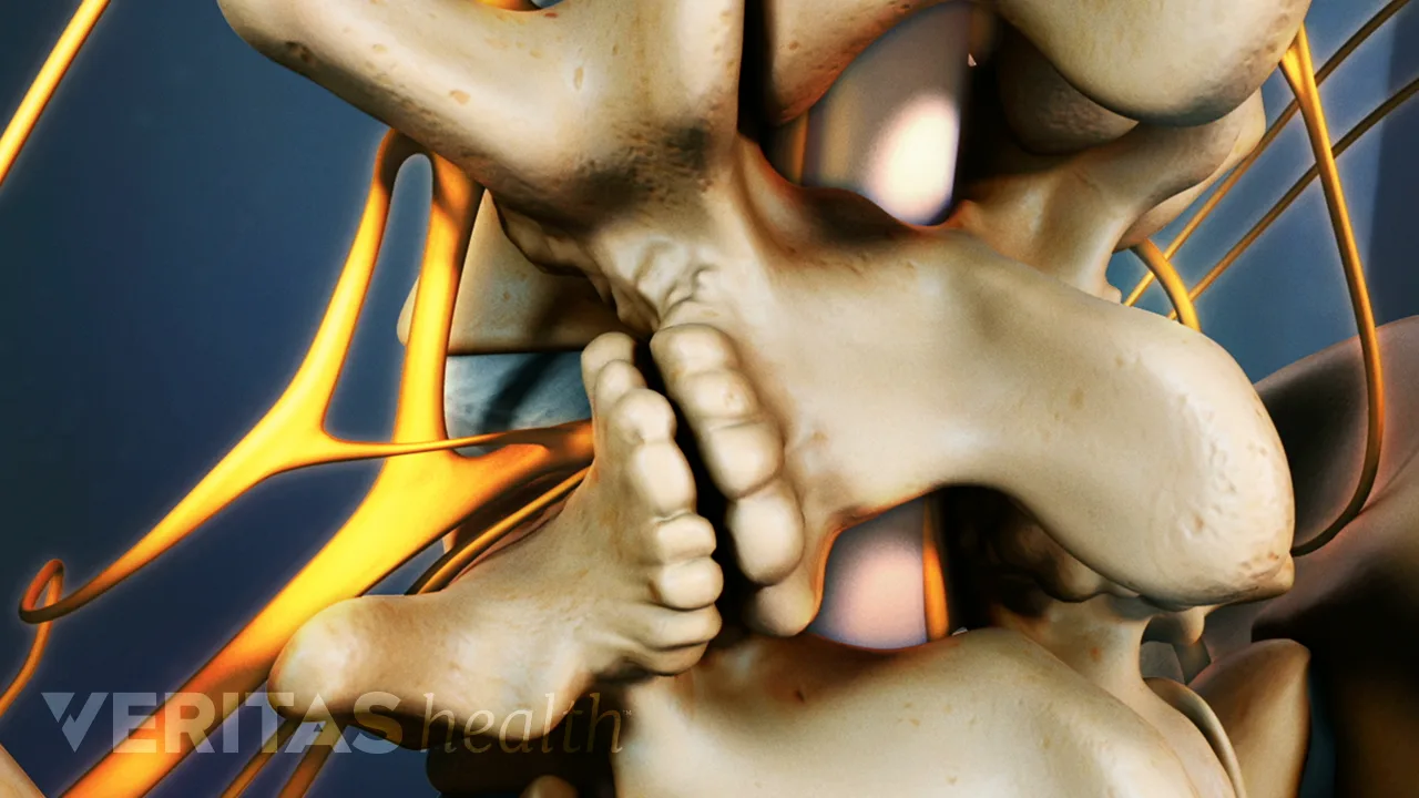 lumbar-spinal-stenosis-cause