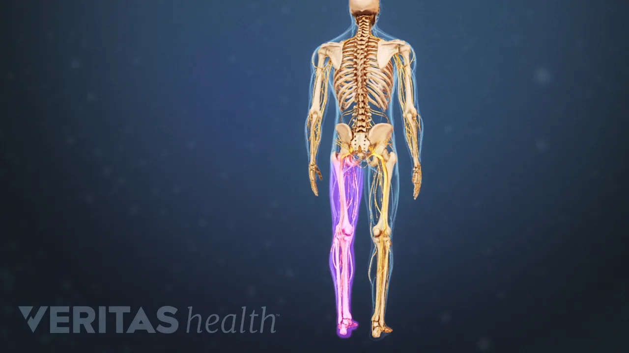 sciatica-one-side-body