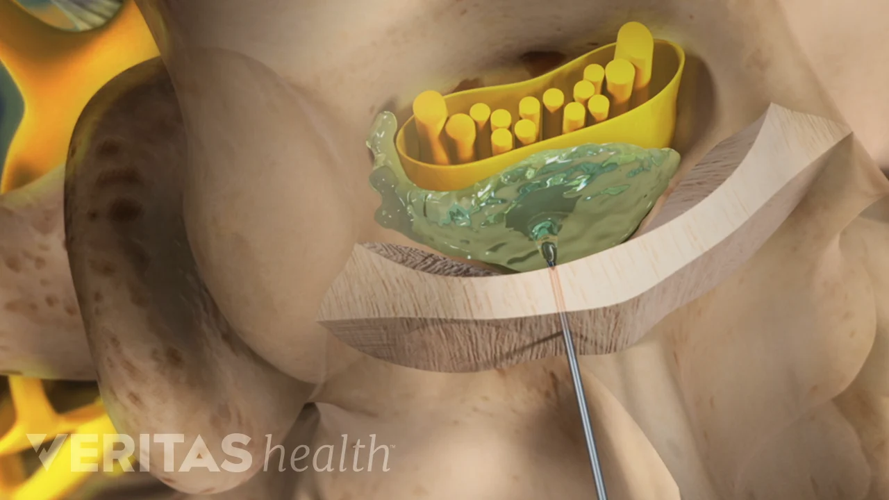 steroid-injection-into-epidural-space