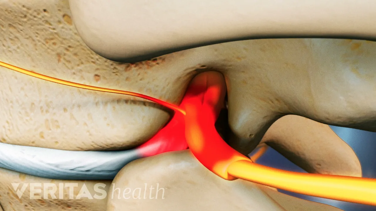 thoracic-herniated-disc-pain