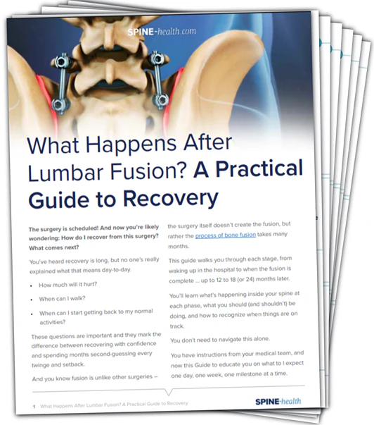What Happens After Lumbar Fusion recovery guide cover