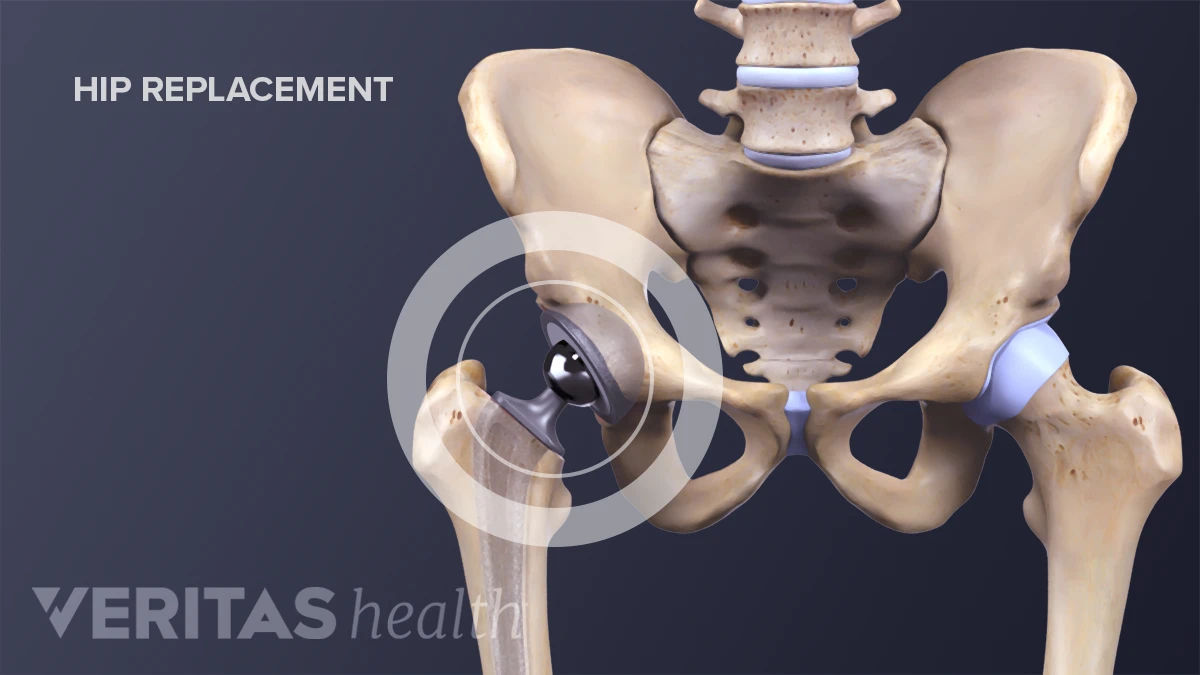 Posterior Hip Bone Acetabular Fractures OrthoInfo AAOS posterior-hip-bone-acetabular-fractures-orthoinfo-aaos