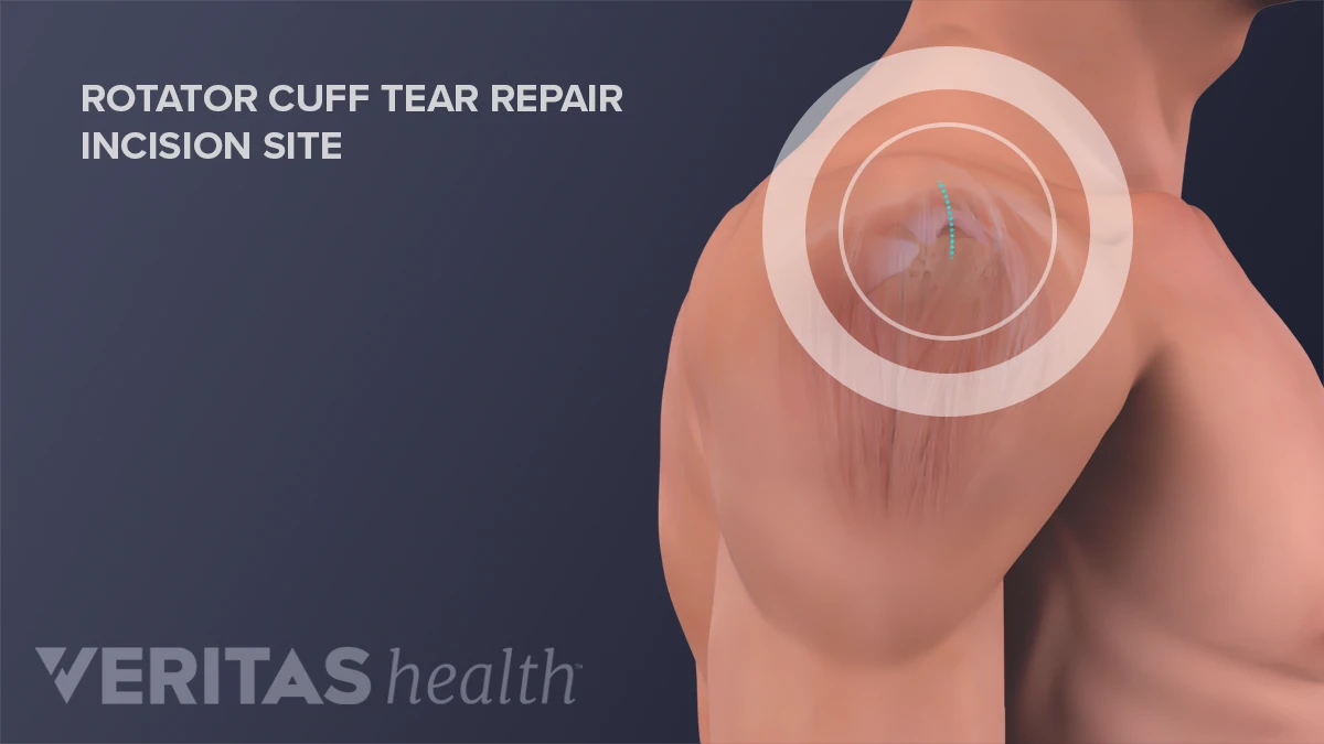 Rotator cuff surgery symptoms discount