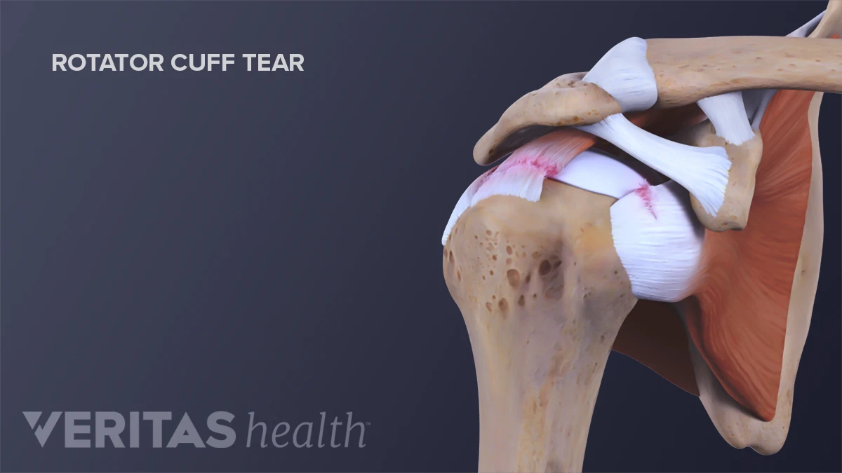 Shoulder Rtc Signs Rotator Cuff Injury Signs Shoulder Pain: Rotator Cuff Vs Frozen