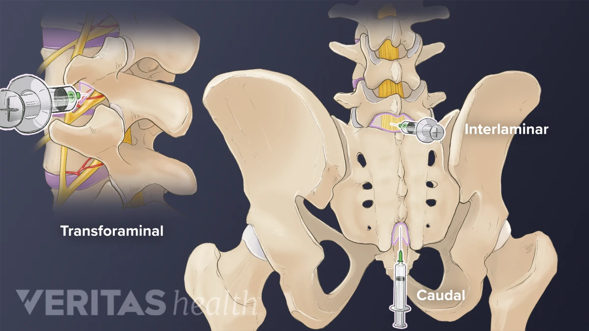 Sij Injection Meaning Sacroiliac Joint Injection Technique