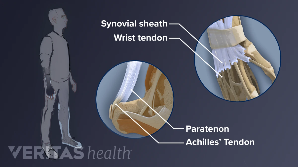 What Is A Tendon Clinical Definition