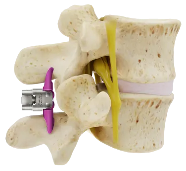 Diagram of the vertebrae after the Vertiflex Procedure.
