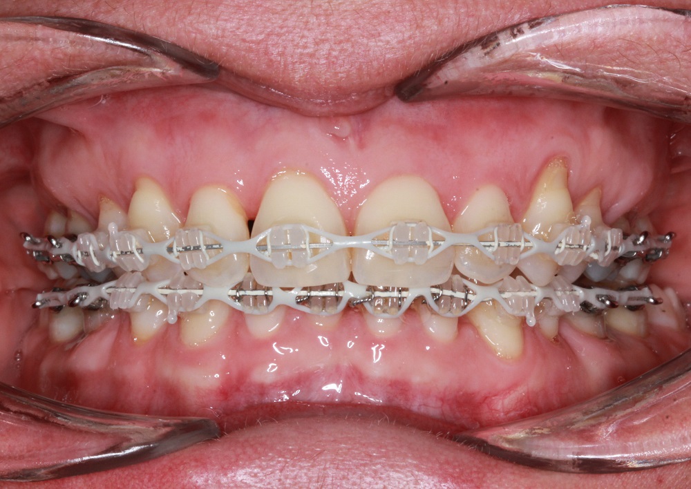Fixed Braces